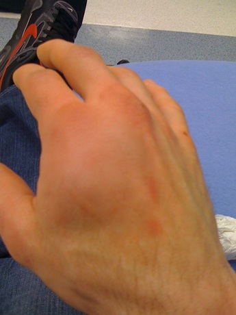 Bowles__broken_hand.jpg